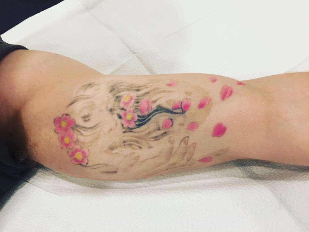 Is Laser Tattoo Removal Worth It?