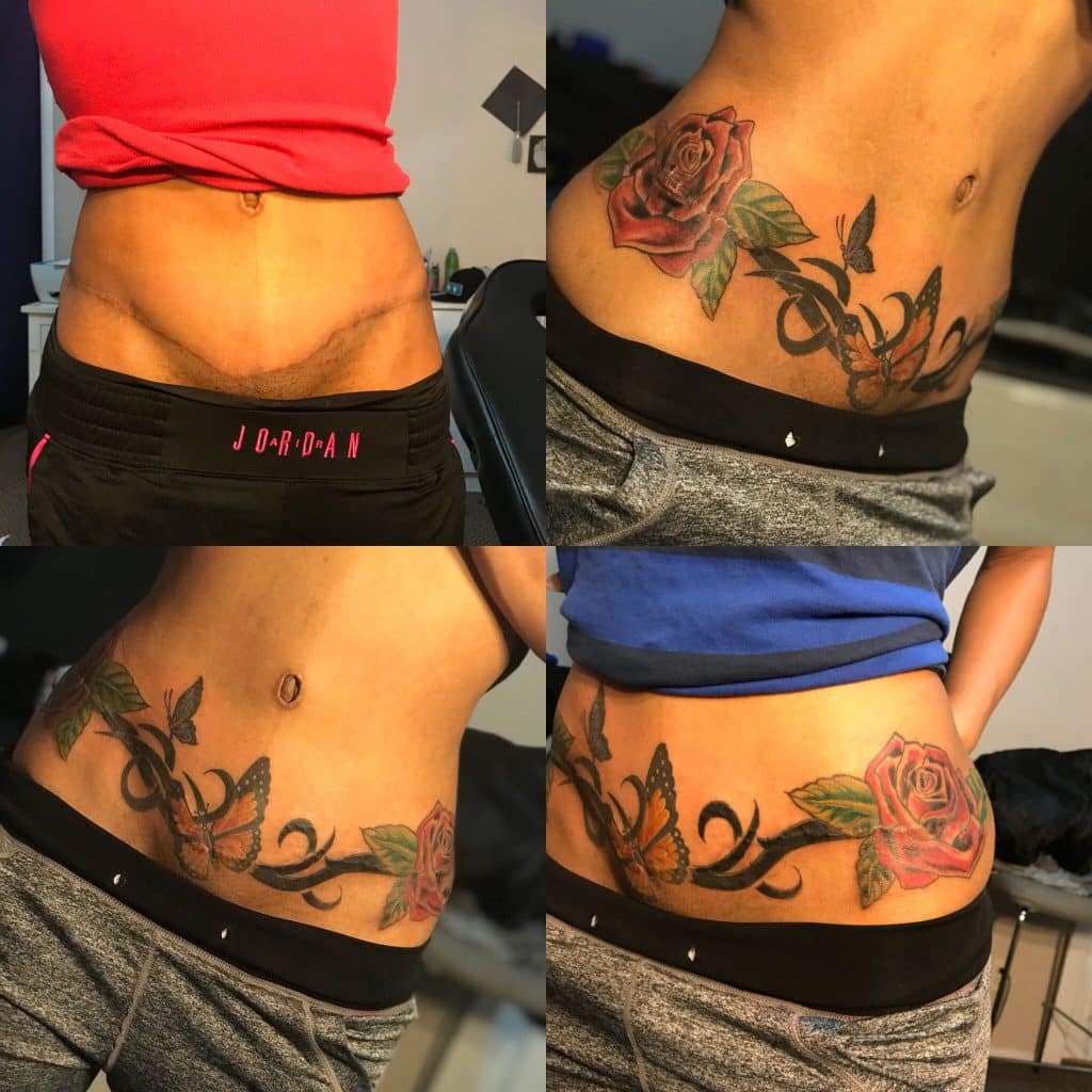 Tummy Tuck Tattoo Cover Up - TattooTalk.net